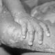 Monkeypox Kills 40-Year-Old As Nigeria Confirms 21 Cases In Nine States