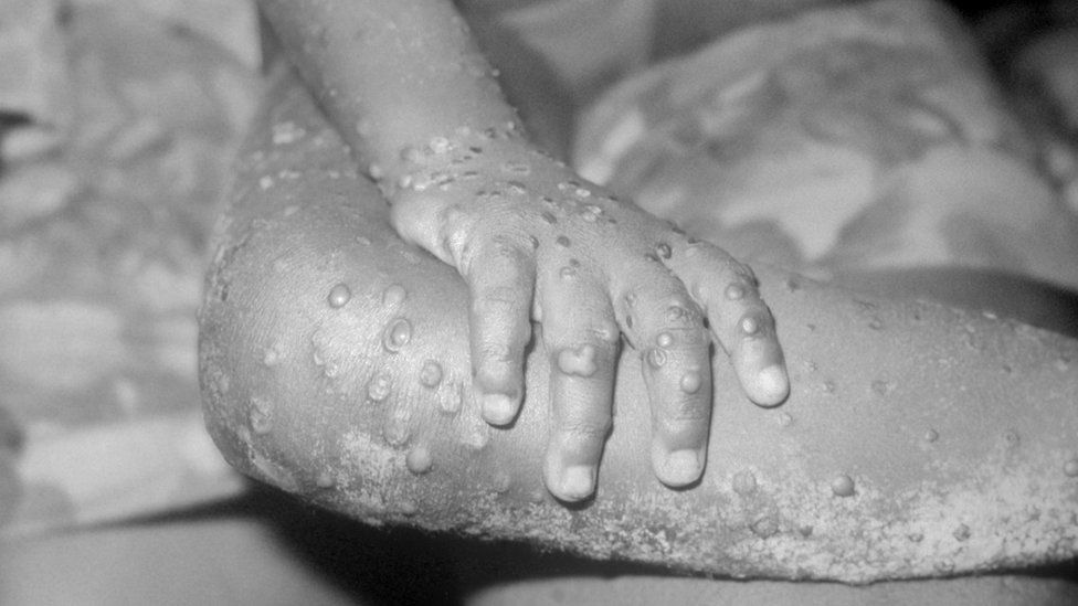Monkeypox Kills 40-Year-Old As Nigeria Confirms 21 Cases In Nine States