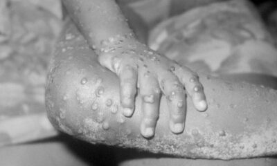 ‘Pure fabrication’ — US denies spreading monkeypox through Nigerian laboratories