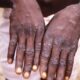 Monkeypox Cases Top 5,000 – WHO