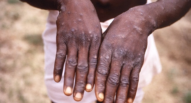 Monkeypox Cases Top 5,000 – WHO