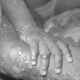 Abia confirms nine cases of Monkeypox