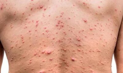 US Declares Monkeypox A Public Health Emergency