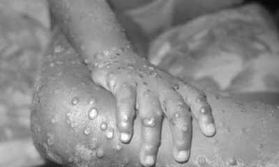 Nigeria’s monkeypox death toll highest in Africa – WHO