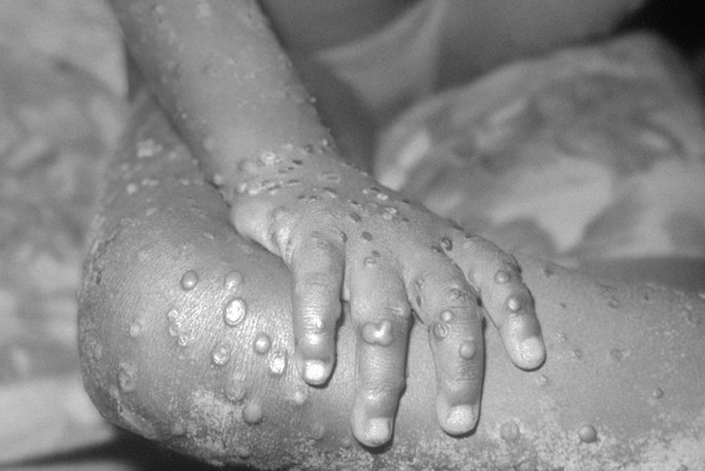 Nigeria’s monkeypox death toll highest in Africa – WHO